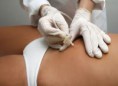 Carboxiterapia